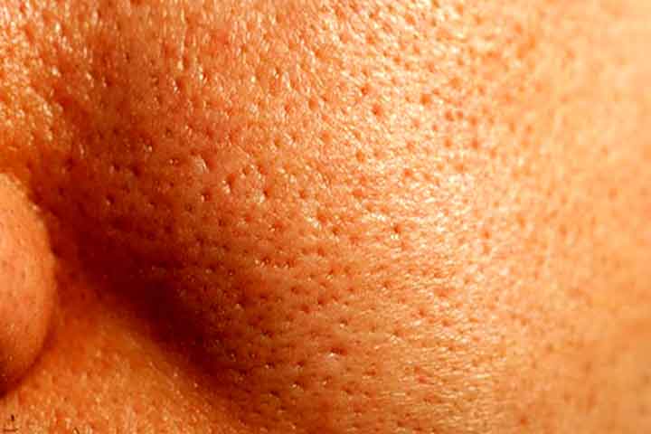 روش های درمان پوست پرتقالی