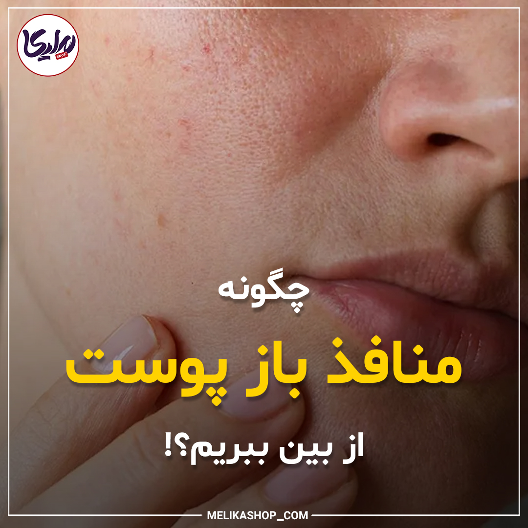 چگونه منافذ باز پوست و از بین ببریم؟
