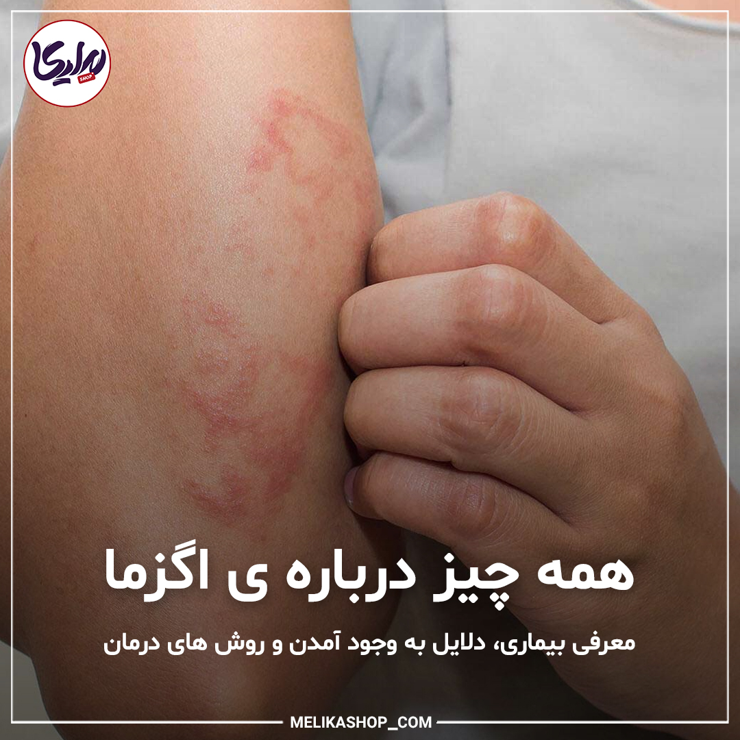 اگزما چیست و روش های درمان اگزما