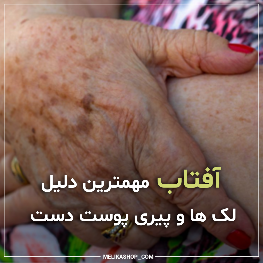 آفتاب مهمترین دلیل لک ها و پیری پوست دست